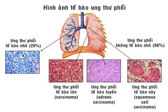 Ung thư phổi có mấy loại? Phân loại và các phương pháp điều trị hiệu quả