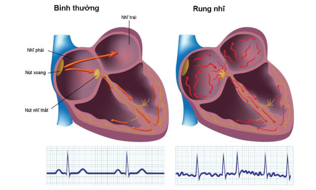 Đột quỵ trong rung nhĩ
