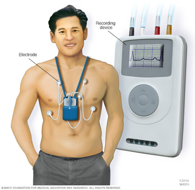 Holter điện tâm đồ chẩn đoán đột quỵ trong rung nhĩ