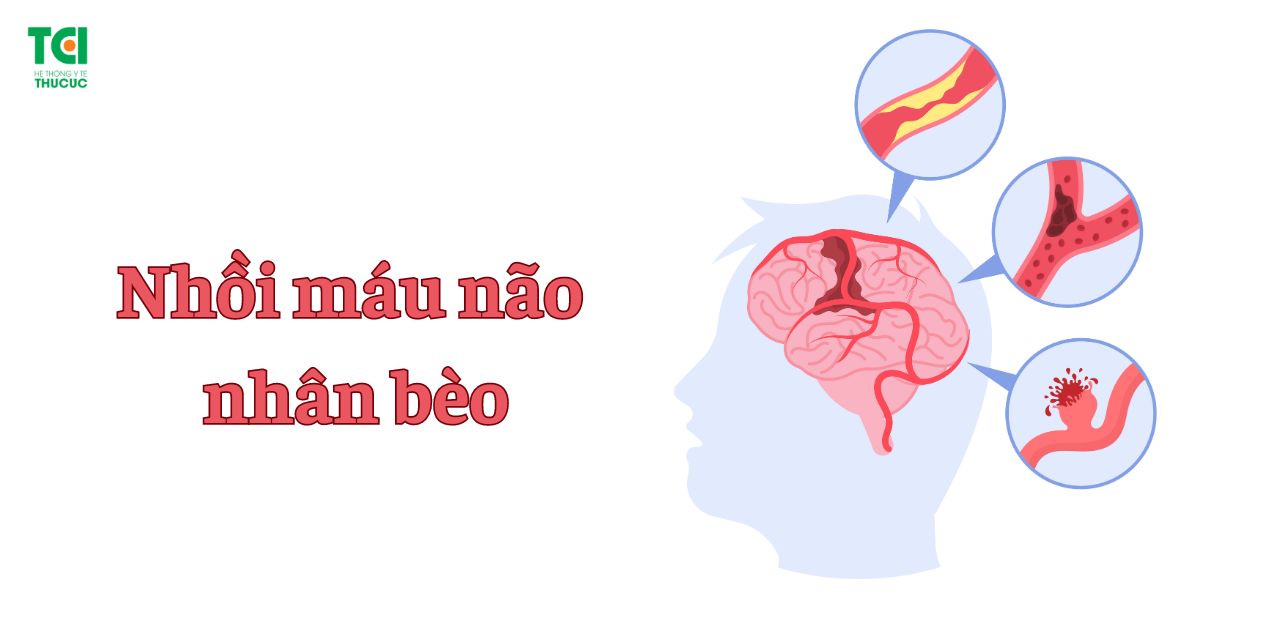 3. Triệu Chứng Của Xuất Huyết Não Nhân Bèo