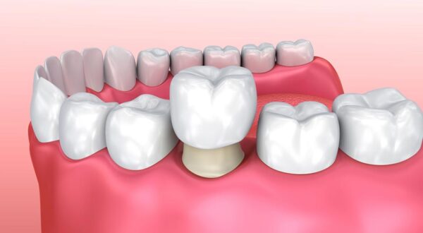 bọc răng sứ xài được bao lâu