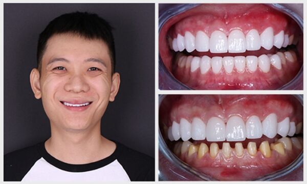 Giải đáp: Có nên bọc răng sứ Zirconia