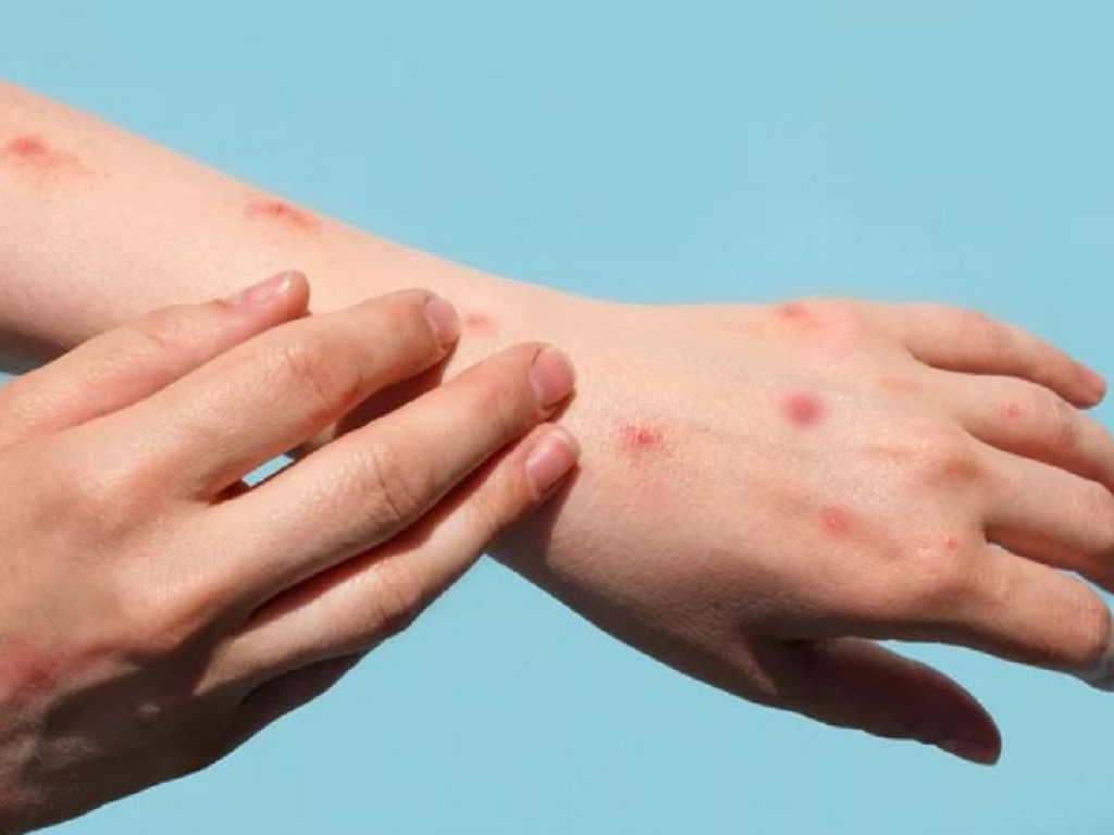 Virus đậu mùa khỉ xâm nhập gây ra các nốt ban ở bàn tay, bàn chân, mặt, bẹn, vùng hậu môn,...