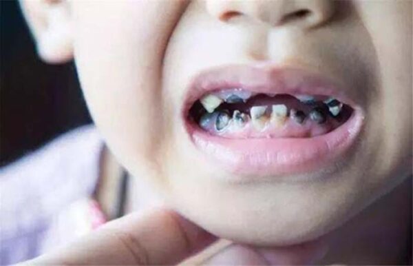 Hàm răng đen là do những nguyên nhân nào?