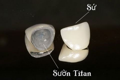 Thông tin về phục hình răng sứ Titan là gì?