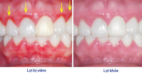 Cách điều trị bệnh viêm chân răng ở phụ nữ sau sinh