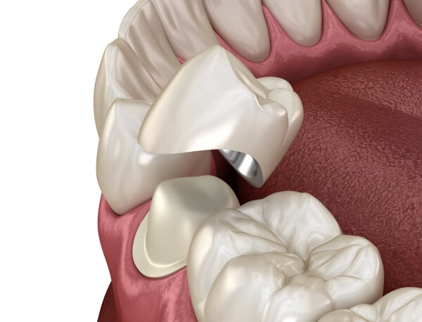 Tìm hiểu giải pháp bọc răng sứ kim loại quý phục hình thẩm mỹ-2
