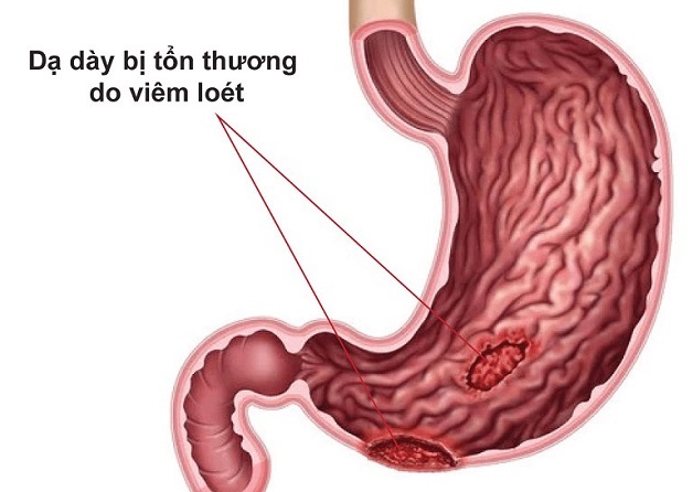 4. Chẩn Đoán Viêm Dạ Dày K29.6