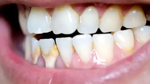 Mảng bám có gây hại cho sức khoẻ răng miệng không
