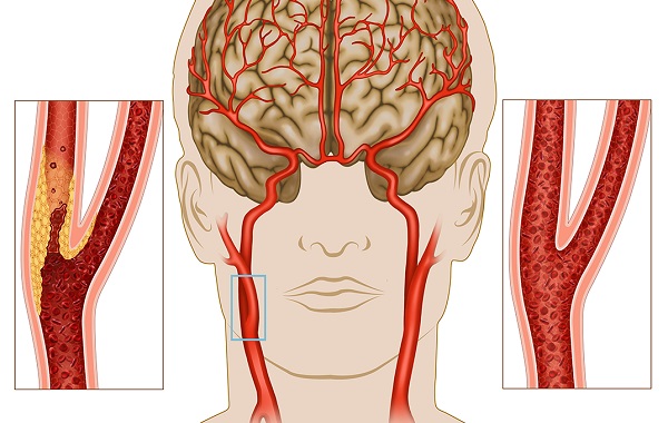 đột quỵ và tình trạng giảm tuổi thọ