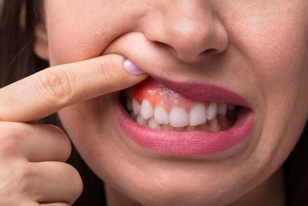 Cao răng là nguyên nhân dẫn đến viêm nướu.