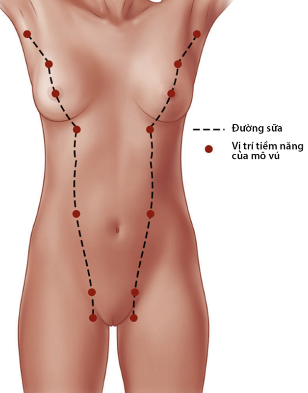 5. Điều trị núm vú phụ