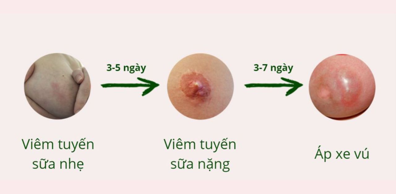 4. Biến Chứng Có Thể Gặp Phải