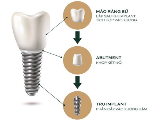 1 cái răng sứ bao nhiêu tiền bao gồm nhiều yếu tố