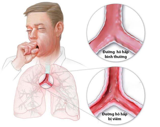 Trào Ngược Dạ Dày Thực Quản ICD 10: Tìm Hiểu Nguyên Nhân, Triệu Chứng và Giải Pháp