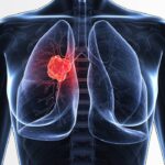 5 Dấu hiệu của bệnh ung thư phổi cần lưu ý