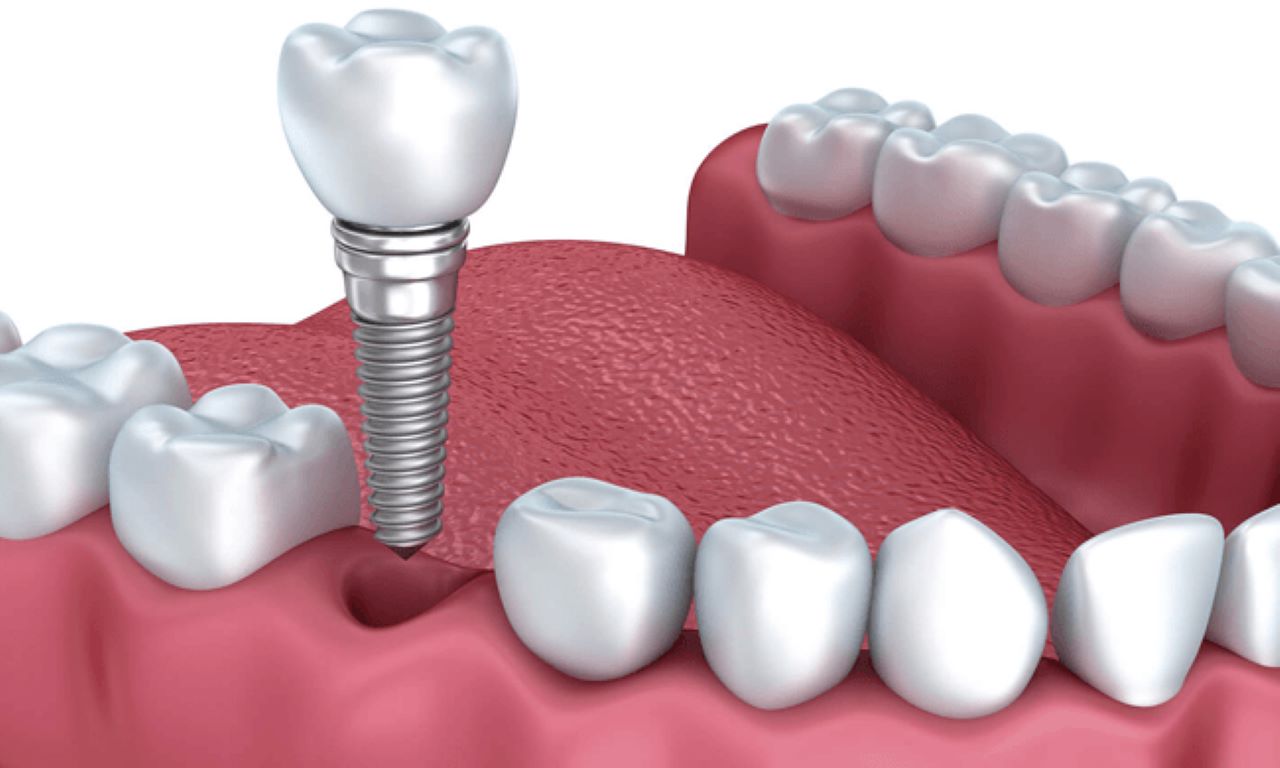 Имплант брянск. Имплантация Нобель. Импланты Nobel Active. Имплантаты Dentium Superline.