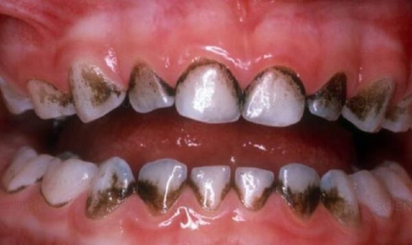 Làm thế nào để khắc phục tình trạng hàm răng đen?