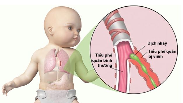 Viêm tiểu phế quản cấp là bệnh lý khá phổ biến ở trẻ dưới 2 tuổi