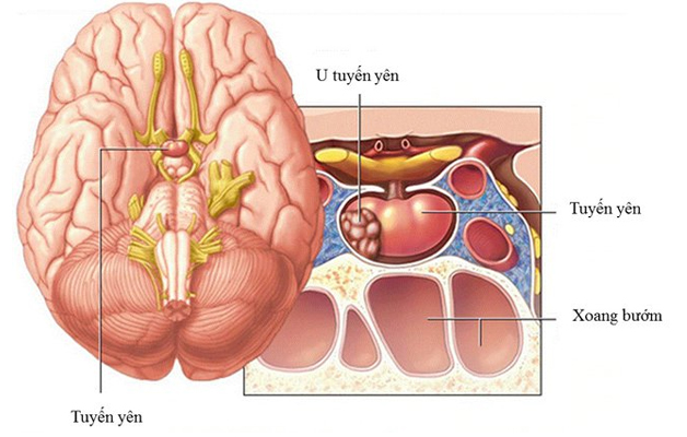 U tuyến yên thuộc TOP 4 các loại u sọ phổ biến, chỉ sau bệnh u thần kinh đệm, u màng não, u bào sợi thần kinh.
