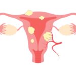 Hiểu rõ về bệnh u xơ tử cung: Triệu chứng, chẩn đoán và điều trị