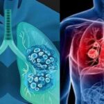 Tổng hợp những triệu chứng của bệnh ung thư phổi điển hình