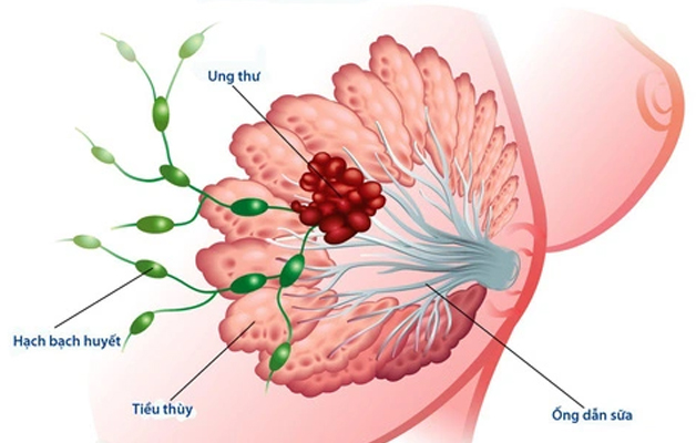 Tổng Quan về Carcinoma Tuyến Vú