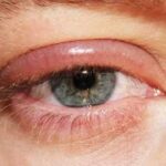 Những điều cần biết về đau mí mắt