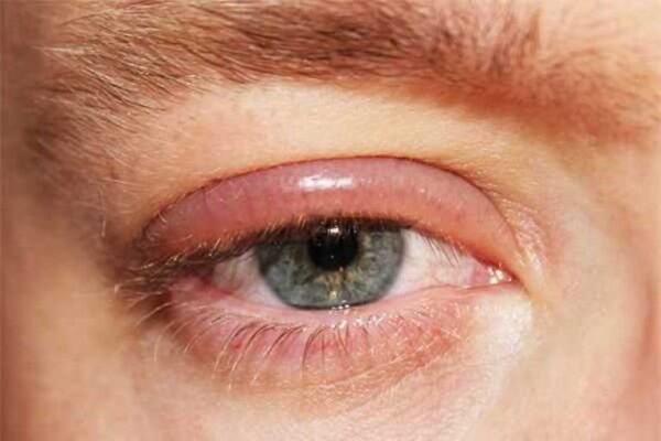 Khái niệm của đau mí mắt là gì?