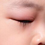 Đau mí mắt trên: Nguyên nhân và cách phòng tránh