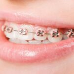 Các giai đoạn niềng răng cơ bản cần lưu ý