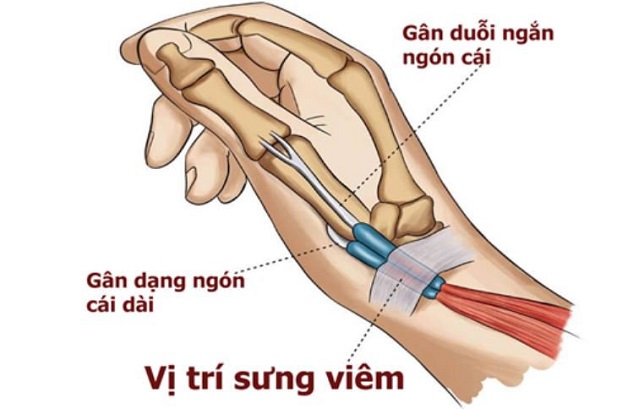 Hội chứng De Quervain là gì? Nguyên nhân, triệu chứng và cách điều trị hiệu quả