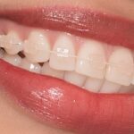 Thực hư về hiệu quả của kỹ thuật niềng răng mắc cài sứ