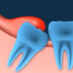 Nhổ răng khôn có nguy hiểm không và 8 nguy cơ biến chứng