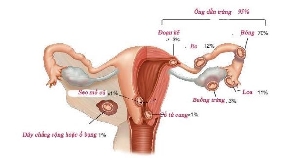 Nguyên Nhân Dẫn Đến Mang Thai Ngoài Tử Cung: Những Điều Bạn Cần Biết