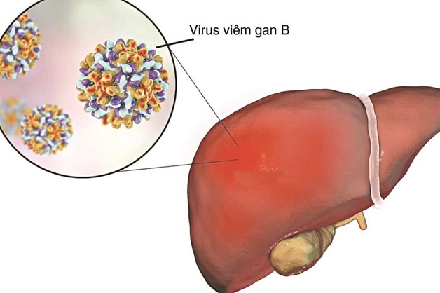 Viêm gan B là căn bệnh gây viêm và tổn thương tế bào gan, có thể diễn biến thành viêm cấp tính hoặc mãn tính