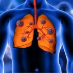 Tiên lượng ung thư phổi di căn và cách điều trị