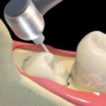 Cách nhổ răng không đau bằng công nghệ Piezotome