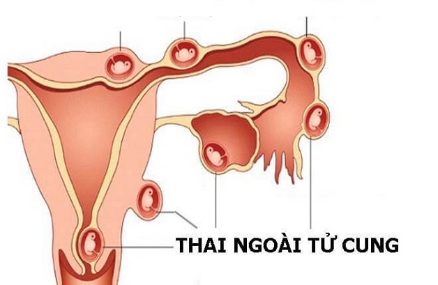 Thai ngoài tử cung là biến chứng sản khoa có thể xảy ra với bất cứ ai