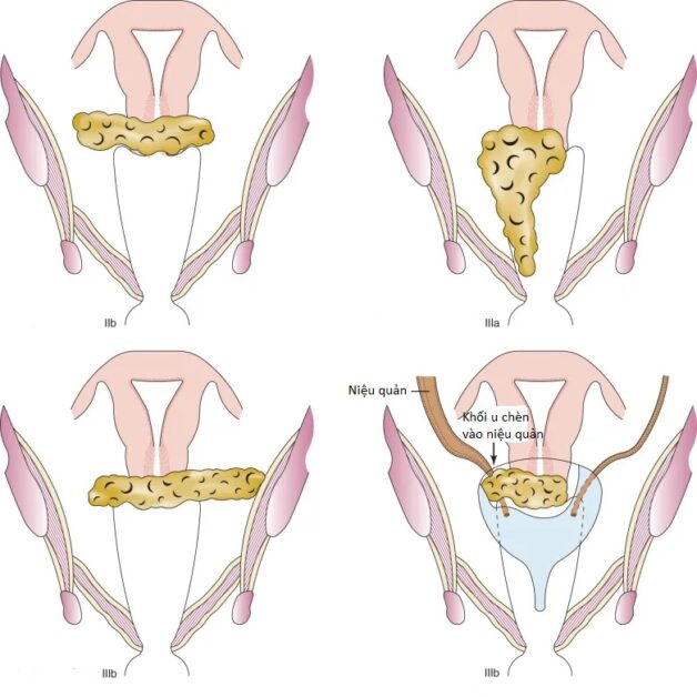 Lời Khuyên Dành Cho Người Bệnh Ung Thư Cổ Tử Cung