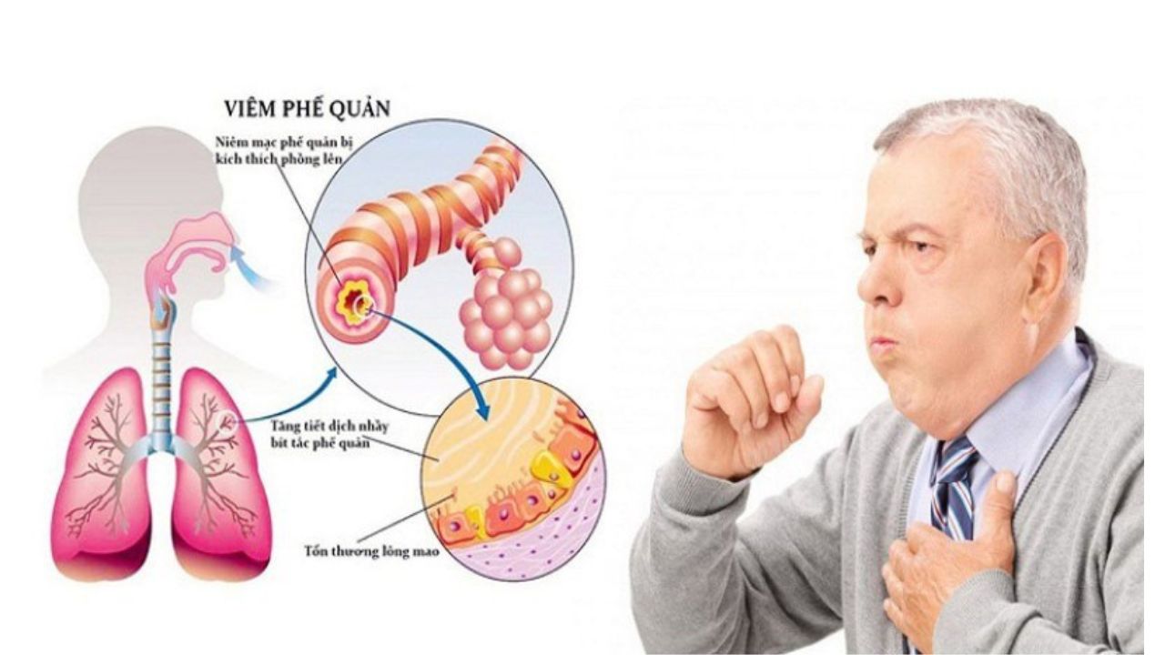 Viêm phế quản