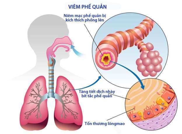 4. Chẩn đoán và điều trị viêm phế quản