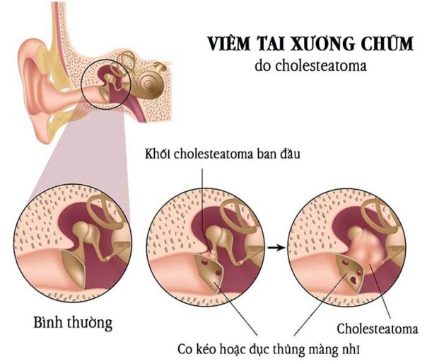 Phương pháp điều trị viêm tai xương chũm có cholesteatoma