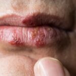 Tìm hiểu về bệnh Herpes lây qua đường tình dục