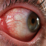 Giải đáp chi tiết: Đau mắt đỏ lây qua đường hô hấp không?
