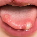 7 Triệu chứng tay chân miệng ở trẻ nhỏ trở nặng