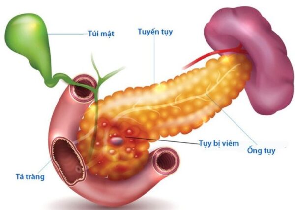 Viêm Tụy Cấp Thể Hoại Tử: Nguyên Nhân, Triệu Chứng Và Cách Điều Trị Hiệu Quả