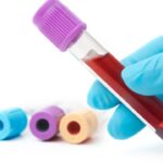 Hiểu rõ chỉ số gan nhiễm mỡ trong xét nghiệm máu