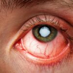 Nguyên nhân đau mắt đỏ phổ biến: Biết để dự phòng