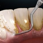 Giải đáp về độ an toàn của các phương pháp loại bỏ cao răng